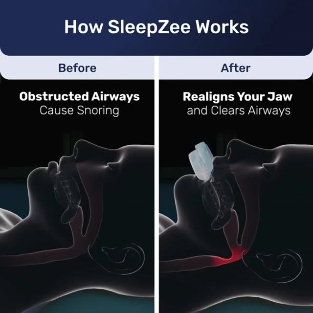 Mandibular Advancement Device image